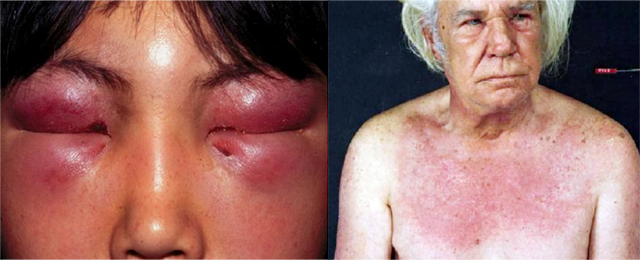 皮肌炎是什么病早期图片